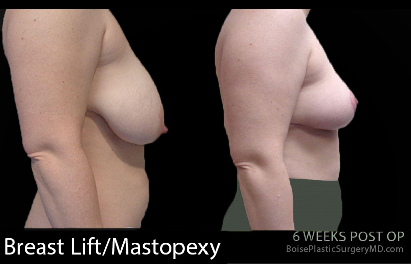 Breast-Lift-Mastopexy-3