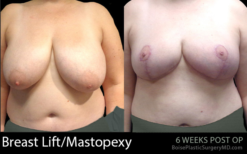 Breast-Lift-Mastopexy-4