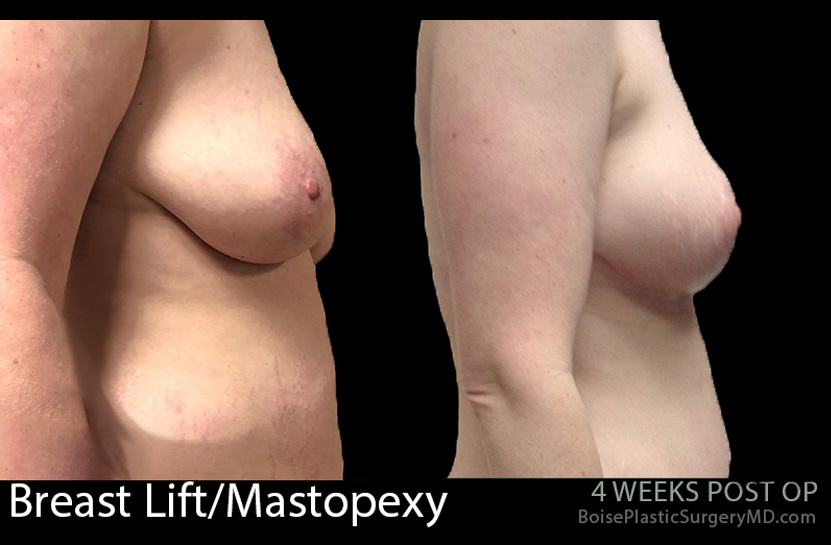 Breast-Lift-Mastopexy-5