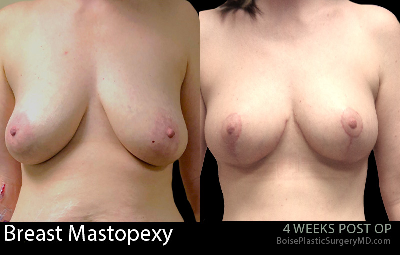 Breast-Lift-Mastopexy-6