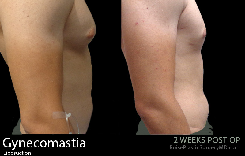 Gynecomastia-2