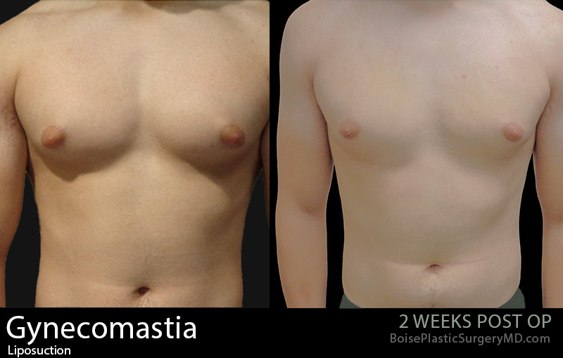 Gynecomastia-1