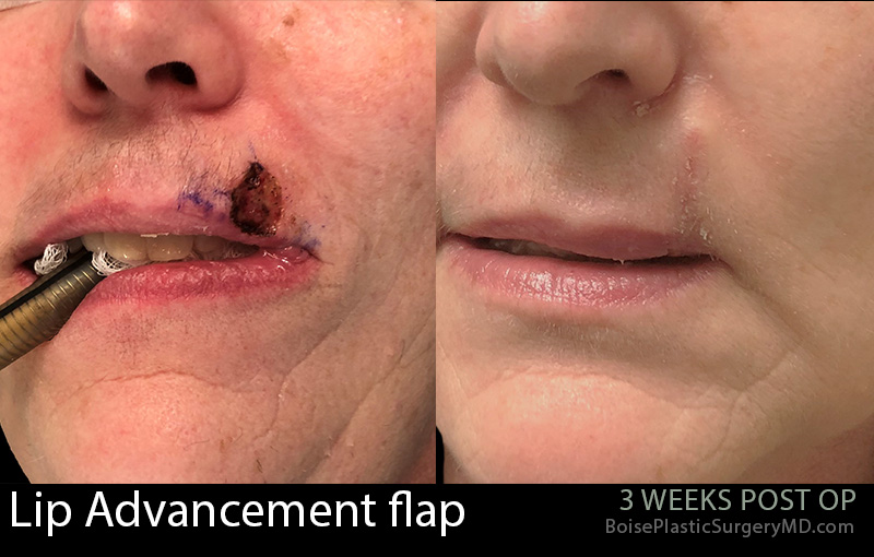Lip-Advancement-Flap-1
