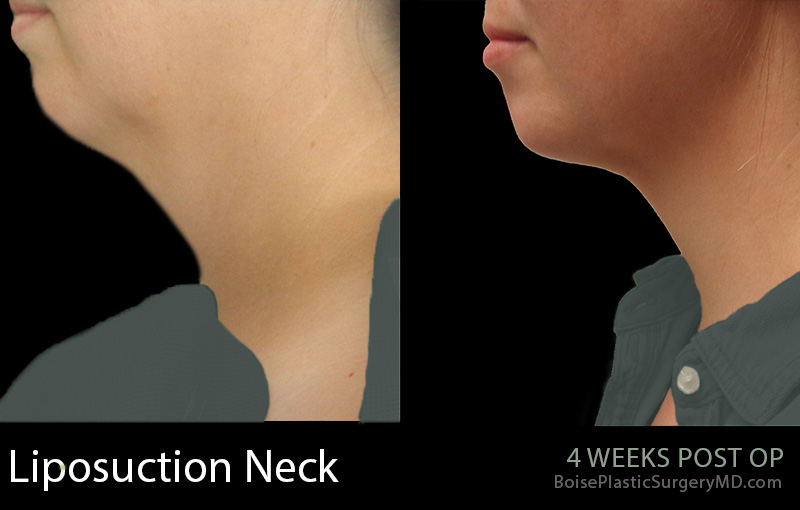 Liposuction-Neck-1