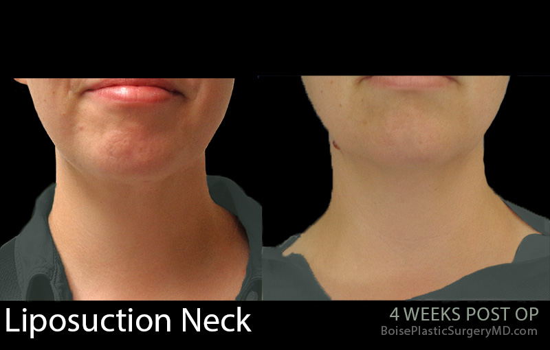 Liposuction Neck 2
