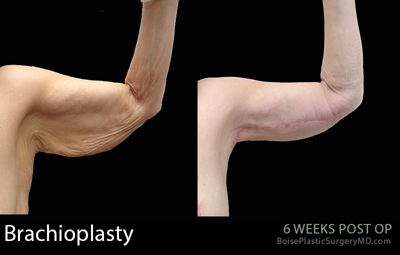 Brachioplasty-3