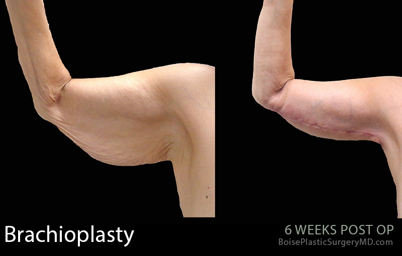 Brachioplasty-4