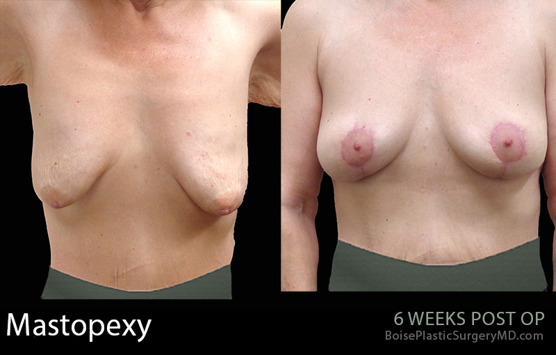 Breast-Lift-Mastopexy-7