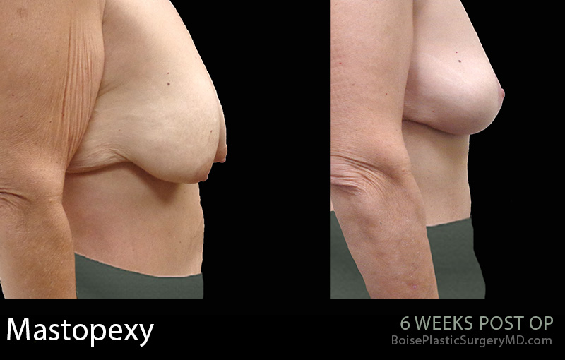 Breast-Lift-Mastopexy-8