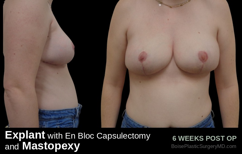 Explant with En Bloc Capsulectomy & Mastopexy