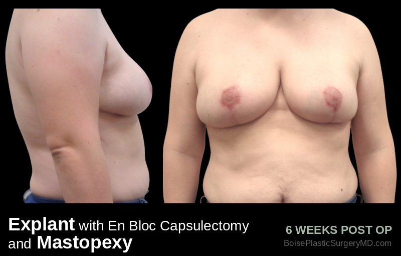 Explant with En Bloc Capsulectomy & Mastopexy