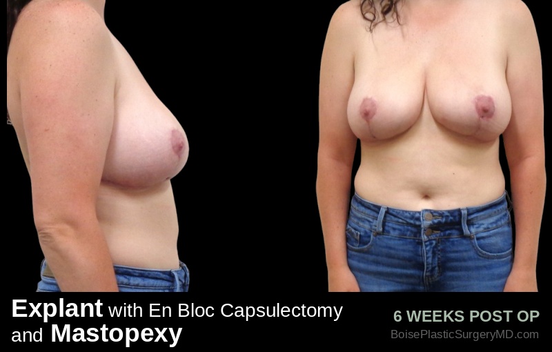 Explant with En Bloc Capsulectomy & Mastopexy