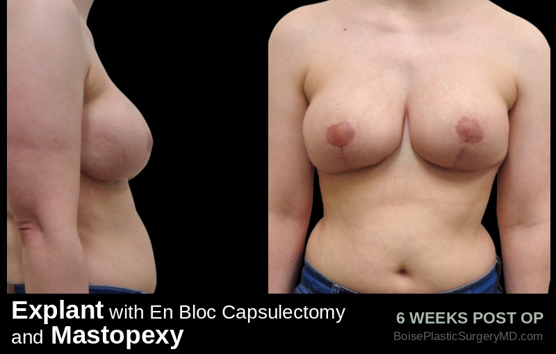 Explant with En Bloc Capsulectomy & Mastopexy