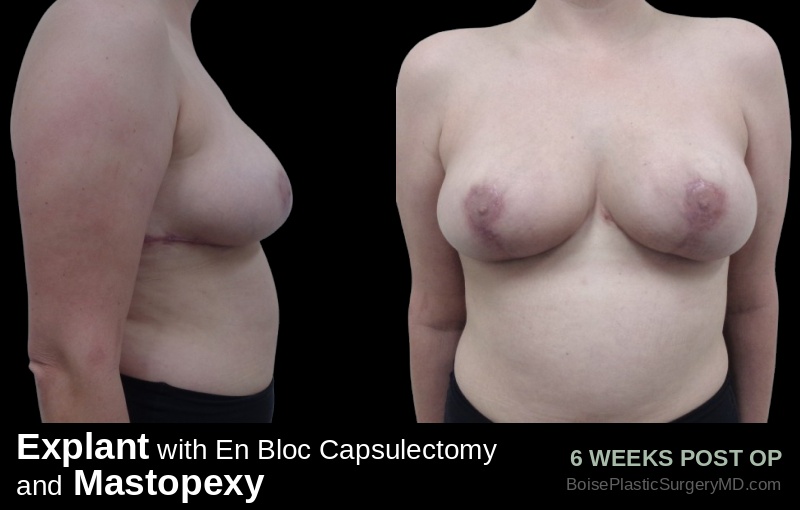 Explant with En Bloc Capsulectomy & Mastopexy