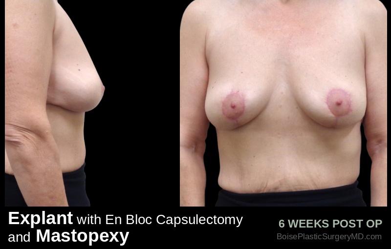 Explant with En Bloc Capsulectomy & Mastopexy