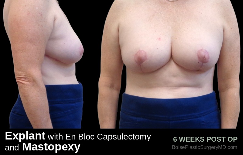 Explant with En Bloc Capsulectomy & Mastopexy