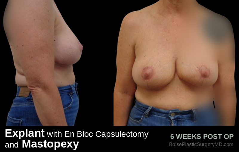 Explant with En Bloc Capsulectomy & Mastopexy